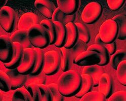 Accumulation of ketone bodies in the blood in diabetes